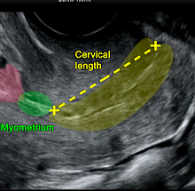 子宮頸管長評価